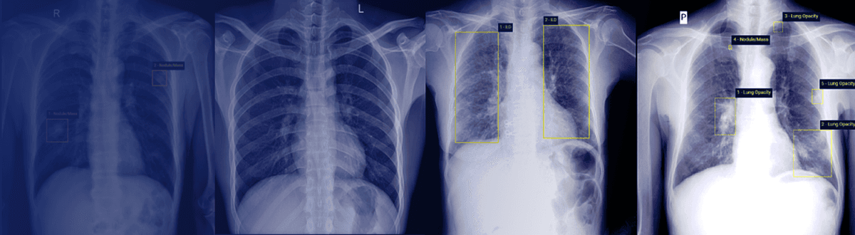 Chest X-ray Abnormalities Detection