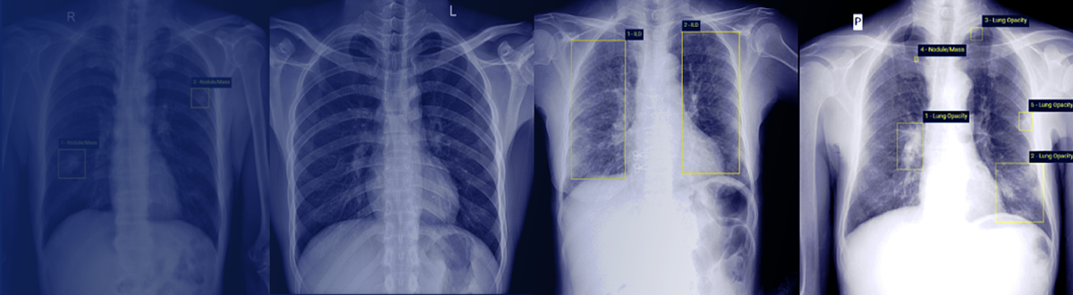 Chest X-ray Abnormalities Detection